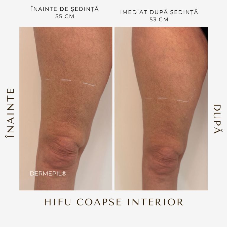 hifu-before-and-after-4.png.jpg