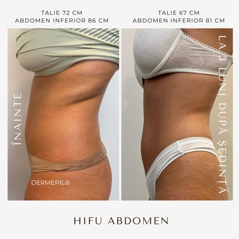 hifu-before-and-after-9.png.jpg