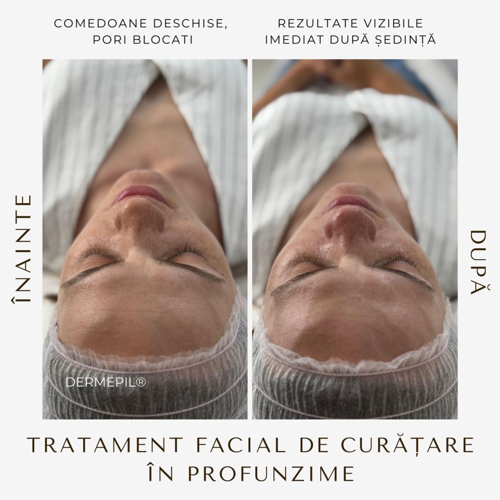 tratament-facial-curatare-5.jpg