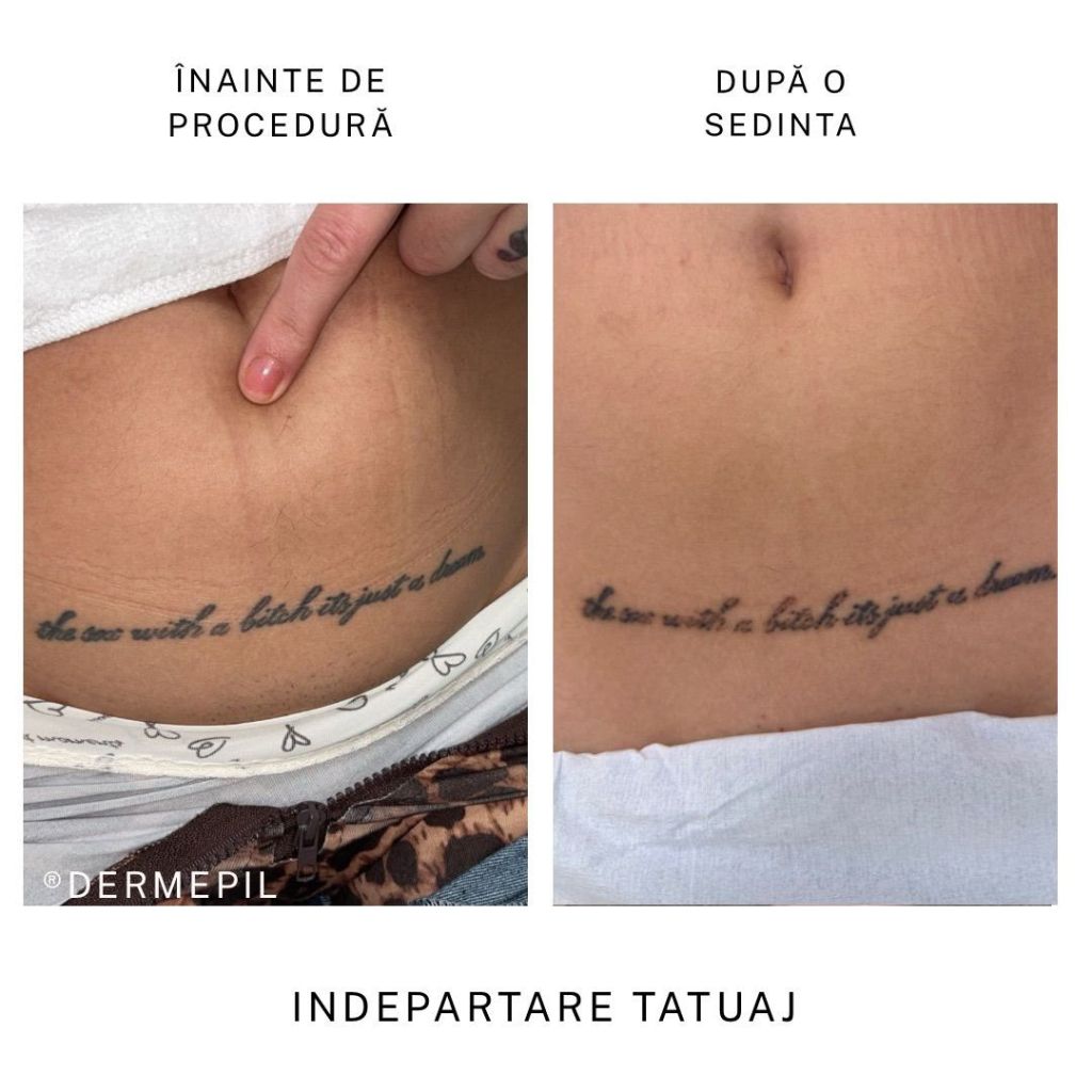 inderpatare tatuaj before after1