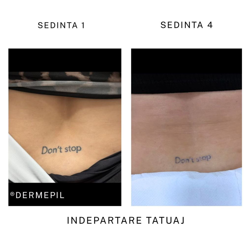 inderpatare tatuaj before after2