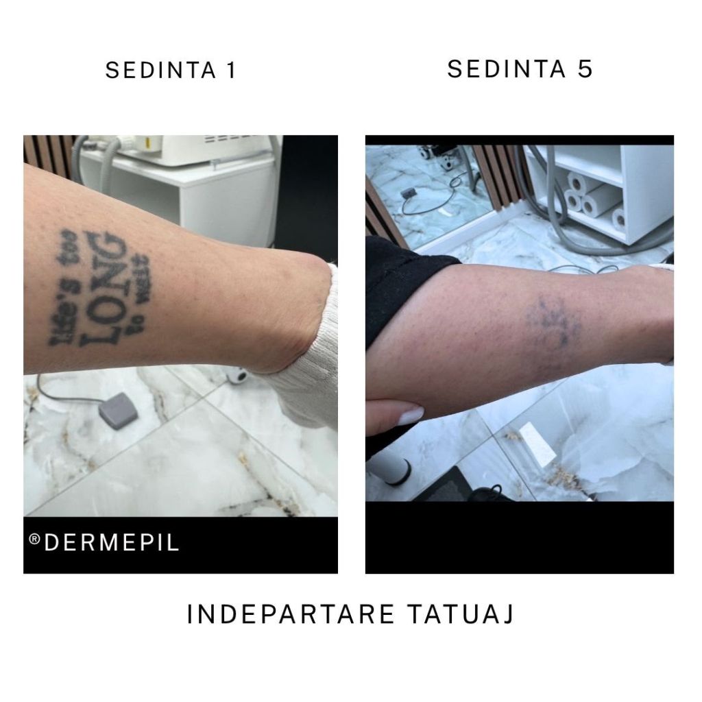 inderpatare tatuaj before after3
