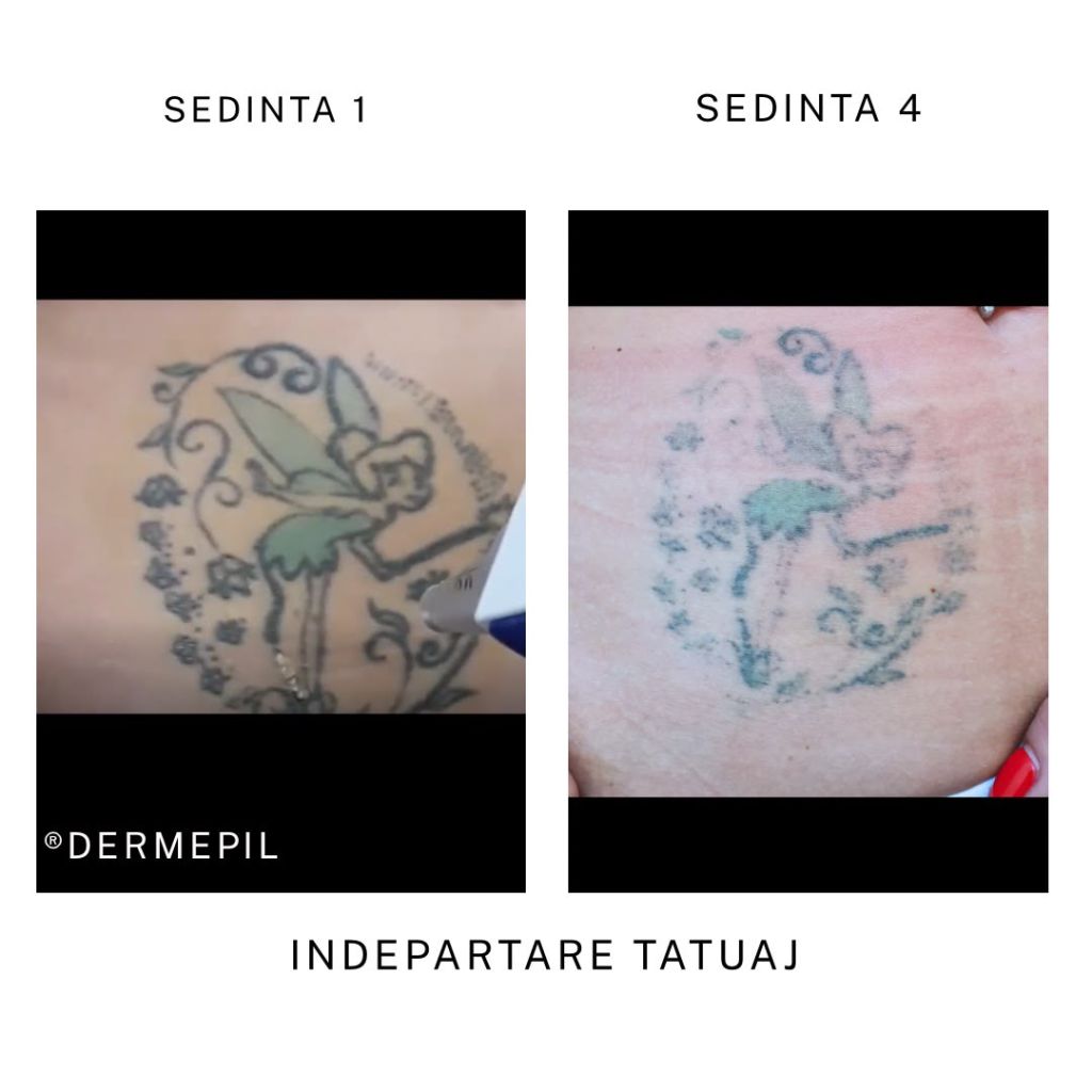 inderpatare tatuaj before after4