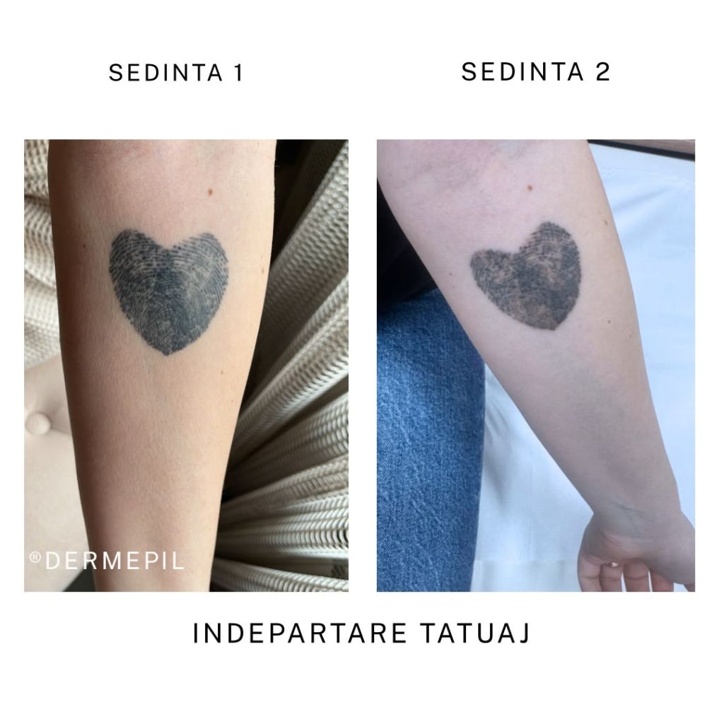 inderpatare tatuaj before after5